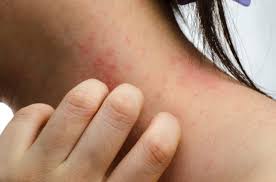 Dermatite allergica: quali sono le cause e come si cura